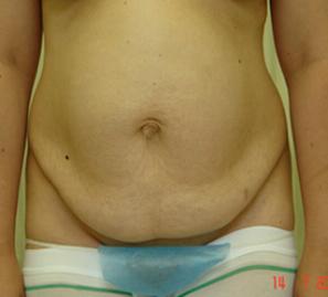 Абдоминопластика -фото до операции (спереди)