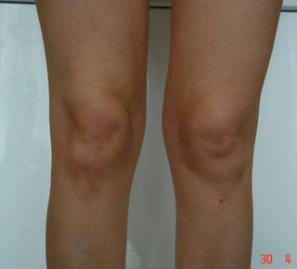 Липосакция внутренней поверхности коленей - фото до операции (спереди)