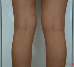 Липосакция внутренней поверхности коленей - фото до операции (сзади)