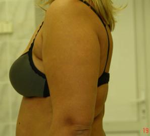 Липосакция и лазерный липолиз задней поверхности плеч и спины - фото до операции (в профиль)