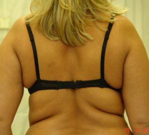 Липосакция и лазерный липолиз задней поверхности плеч и спины - фото до операции (сзади)