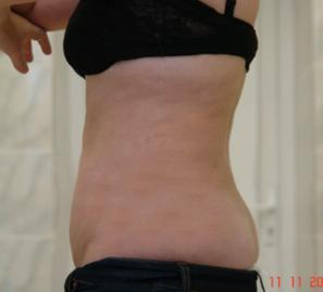 Липосакция спины, верхнего и нижнего отдела живота - фото после операции (в профиль)
