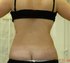 Липосакция спины, верхнего и нижнего отдела живота - фото после операции (сзади)