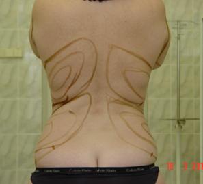 Липосакция спины, верхнего и нижнего отдела живота - фото до операции (сзади)