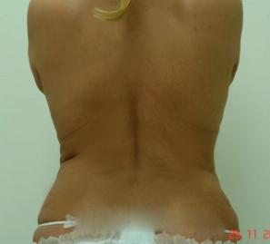 Липосакция спины и талии - фото после операции (сзади)