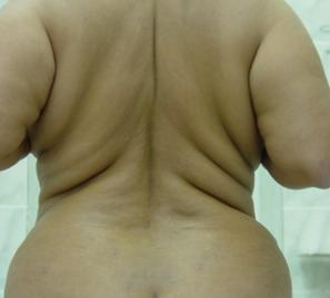 Липосакция спины и талии - фото до операции (сзади)