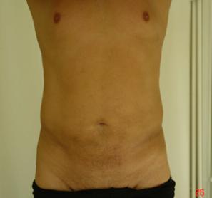 Липосакция живота,боков мужчине - фото после операции (спереди)