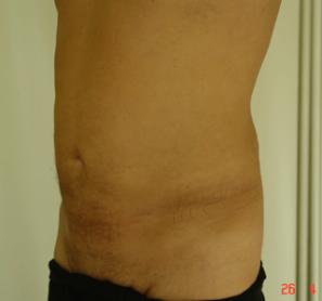 Липосакция живота,боков - фото после операции (справа)