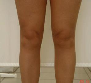 Липосакция колен - фото после операции