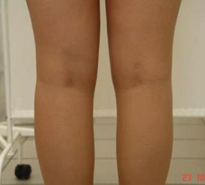Липосакция колен - фото после операции (сзади)