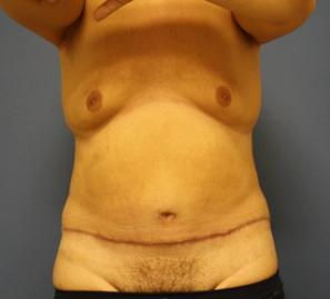 Абдоминопластика живота фото после операции (спереди)